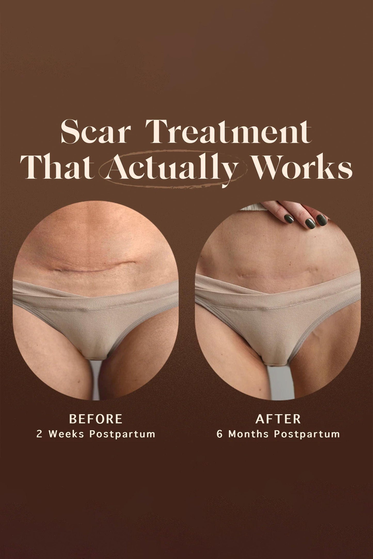 postpartum scar treatment